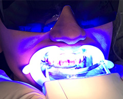 Clareamento Dental a Laser - Clínica Sorriso Santana