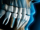 Implante Dentário | Clínica Sorriso Santana