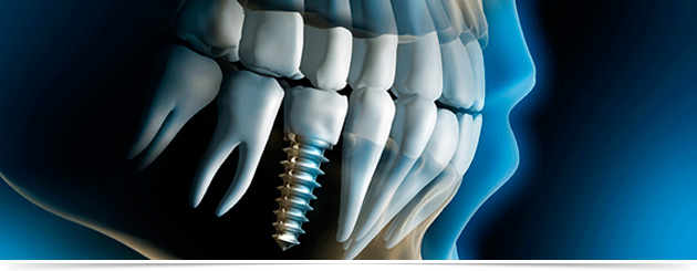 Implante Dentário | Clínica Sorriso Santana