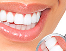 Clareamento Dental | Clínica Sorriso Santana